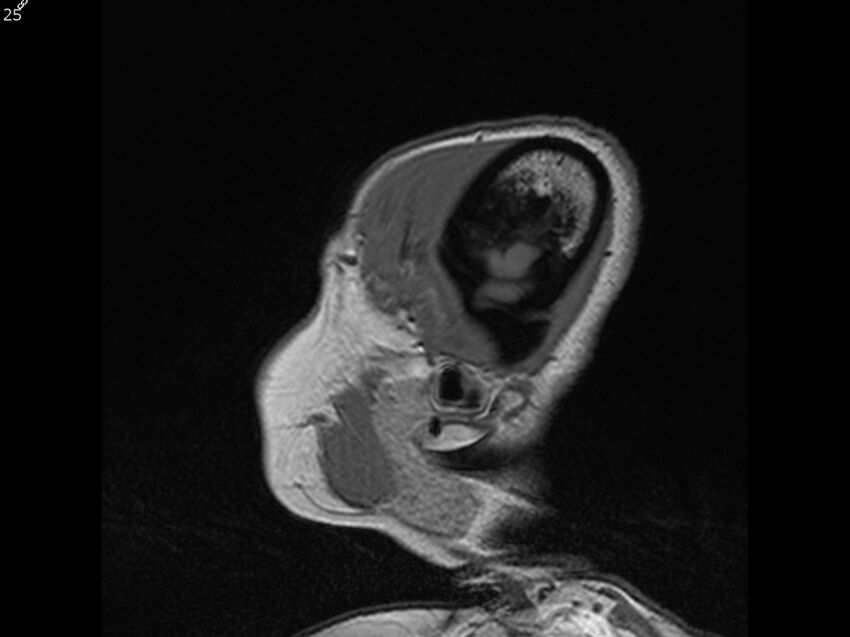 Atypical meningioma - intraosseous (Radiopaedia 64915-74572 Sagittal T1 25).jpg