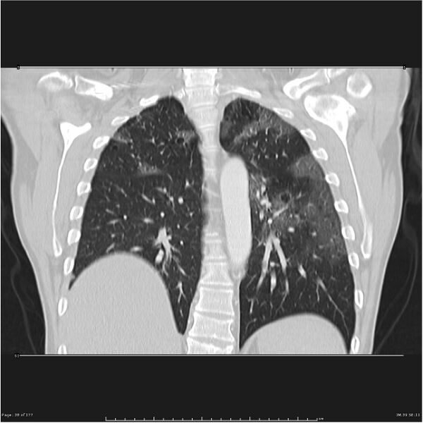 File:Atypical pneumonia - Q fever (Radiopaedia 21993-21989 C 31).jpg