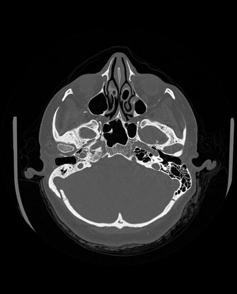 File:Automastoidectomy with labyrinthine fistula (Radiopaedia 84143-99411 Axial non-contrast 80).jpg