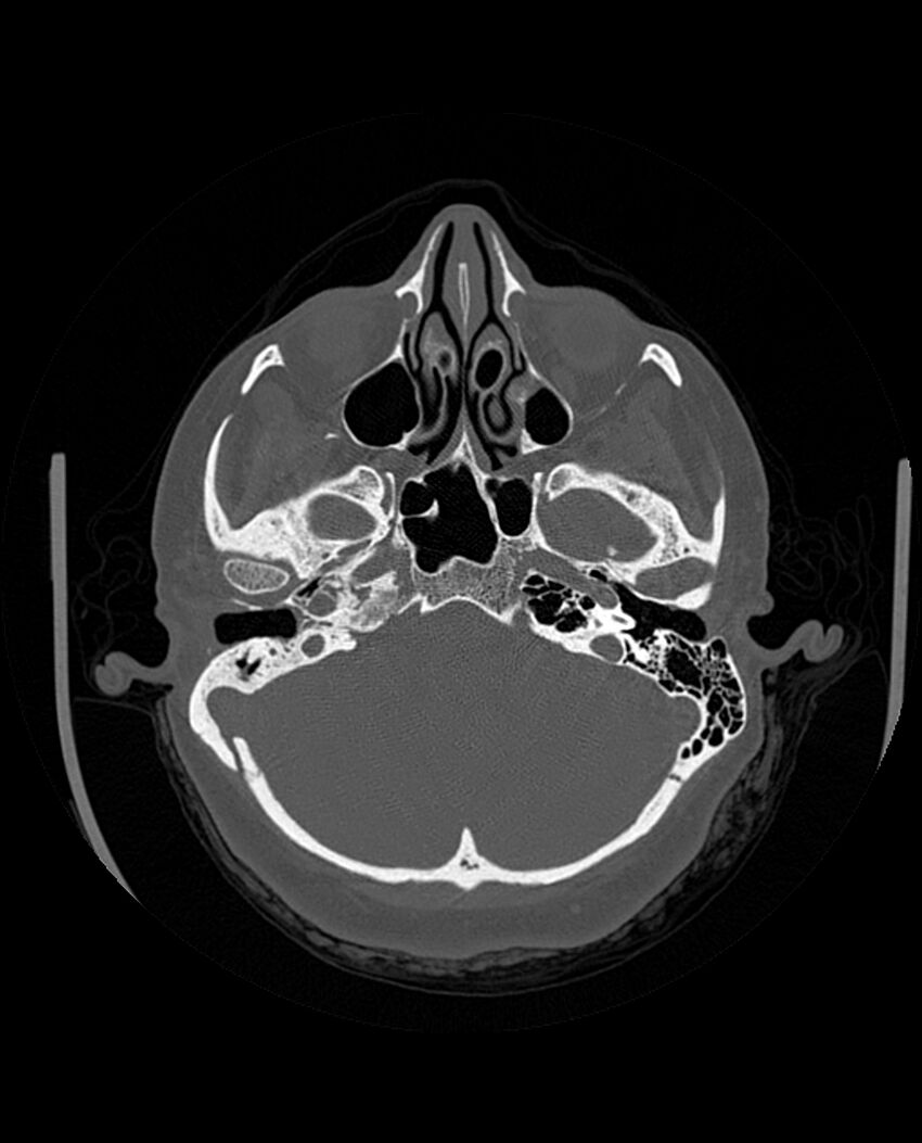 Automastoidectomy with labyrinthine fistula (Radiopaedia 84143-99411 Axial non-contrast 80).jpg