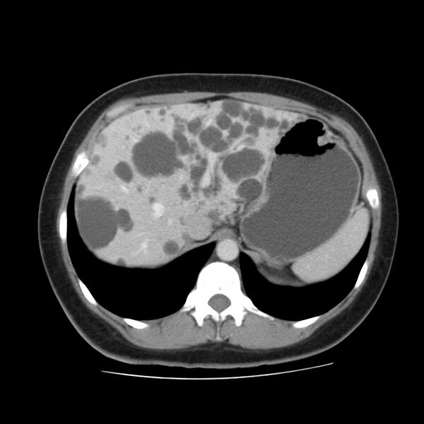 File:Autosomal dominant polycystic kidney disease (Radiopaedia 23061-23093 C 14).jpg