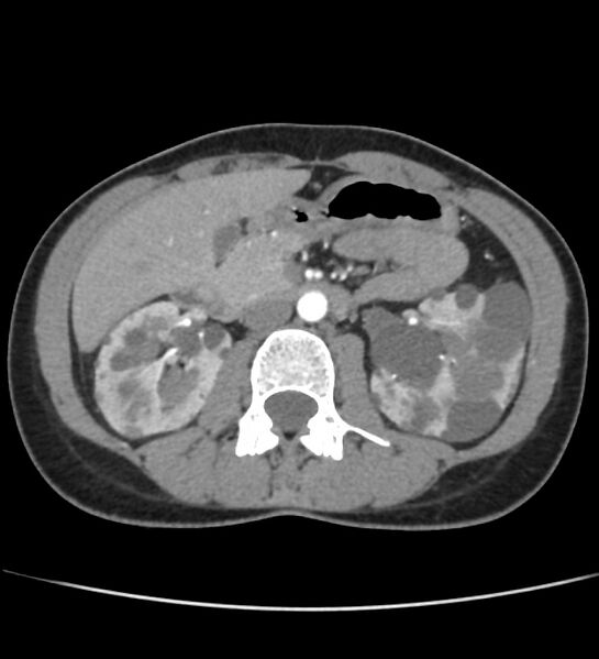 File:Autosomal dominant polycystic kidney disease - early onset (Radiopaedia 40734-43387 B 25).jpg