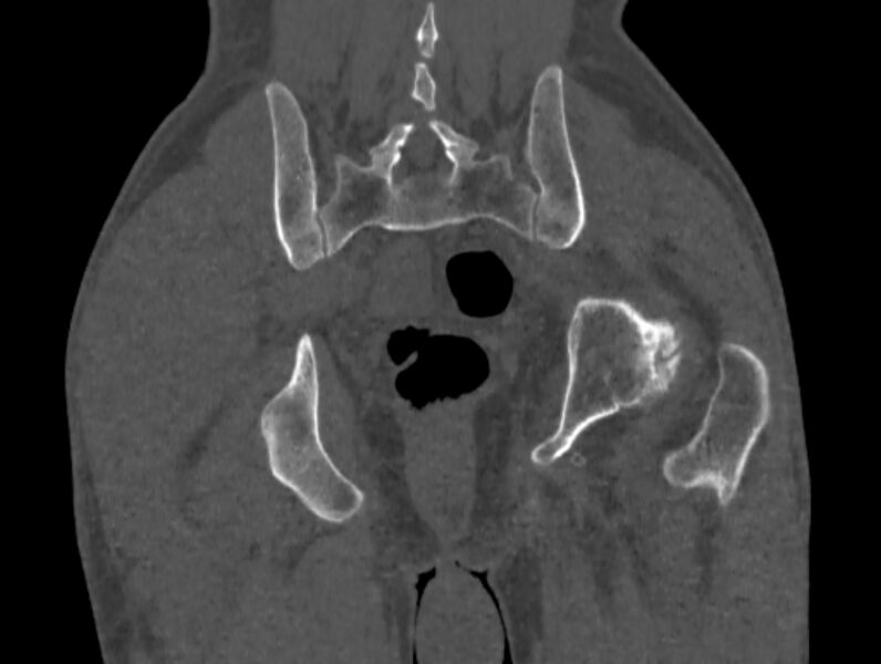 File:Avascular necrosis of the left hip (Radiopaedia 75068-86125 Coronal bone window 79).jpg