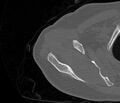 Avulsion fracture - greater tuberosity of humerus (Radiopaedia 71216-81514 Axial bone window 20).jpg