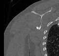 Avulsion fracture - greater tuberosity of humerus (Radiopaedia 71216-81514 Coronal bone window 59).jpg