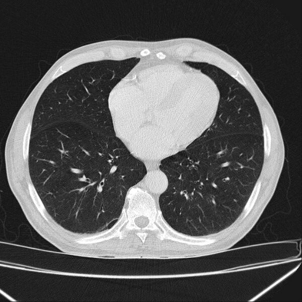 File:Azygos lobe (Radiopaedia 38259-40275 Axial lung window 56).jpg