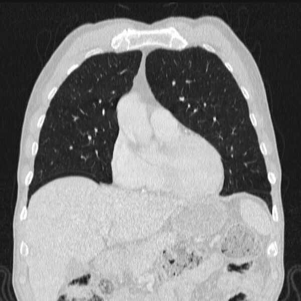 File:Azygos lobe (Radiopaedia 38259-40275 Coronal lung window 26).jpg