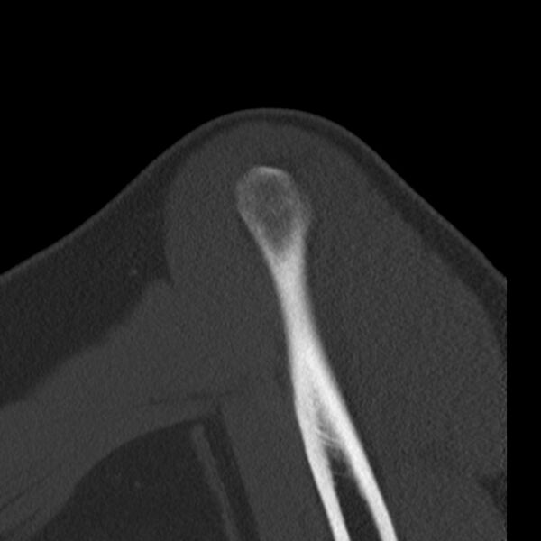 File:Bankart lesion (Radiopaedia 22771-22798 Sagittal bone window 3).jpg