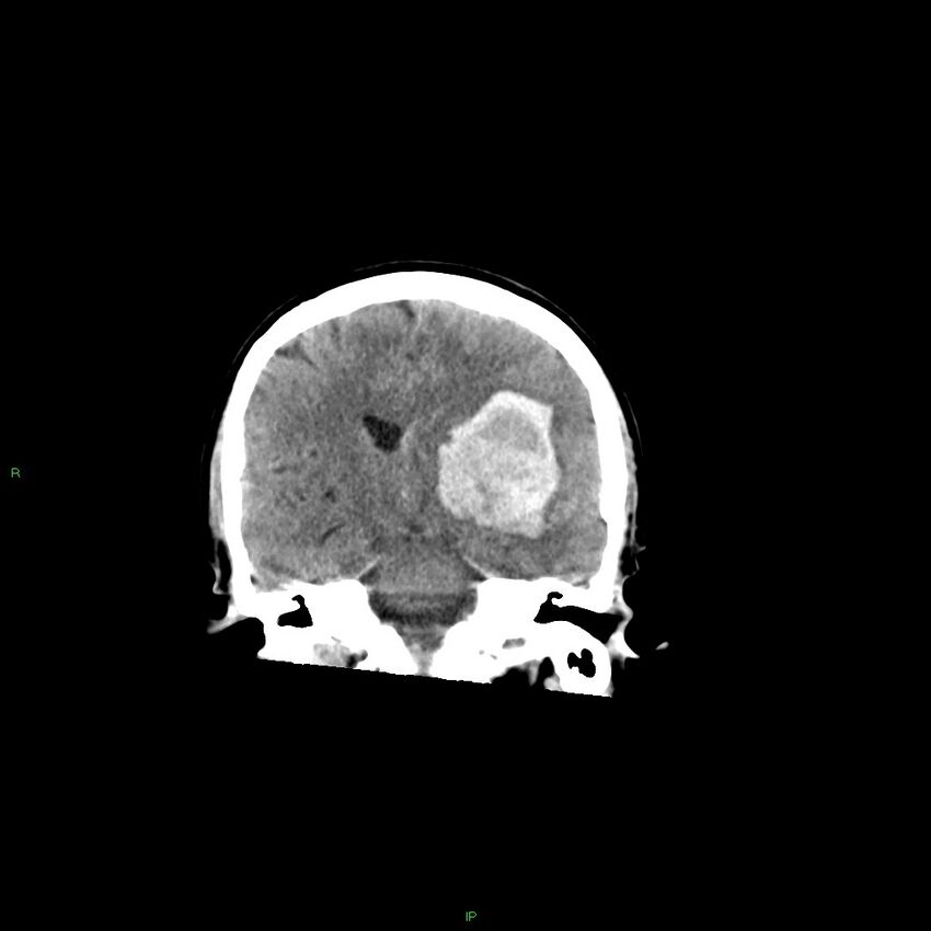 Basal ganglia hemorrhage (Radiopaedia 58349-65472 Coronal non-contrast 34).jpg