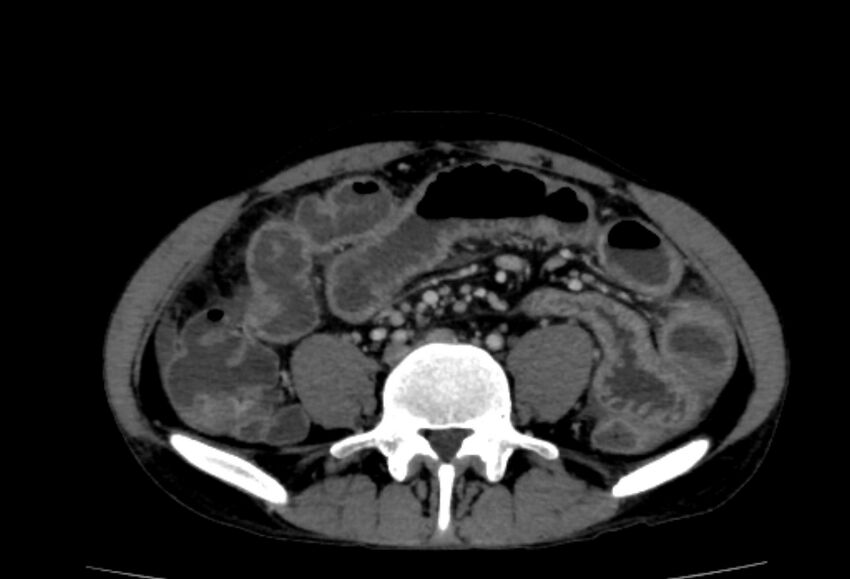 Behçet's disease- abdominal vasculitis (Radiopaedia 55955-62570 A 54).jpg