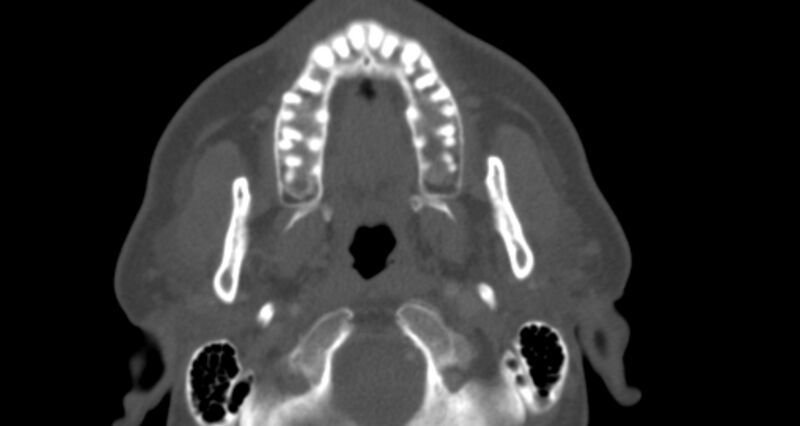 File:Benign mixed salivary tumor of the parotid gland (Radiopaedia 35261-36792 Axial bone window 14).jpg