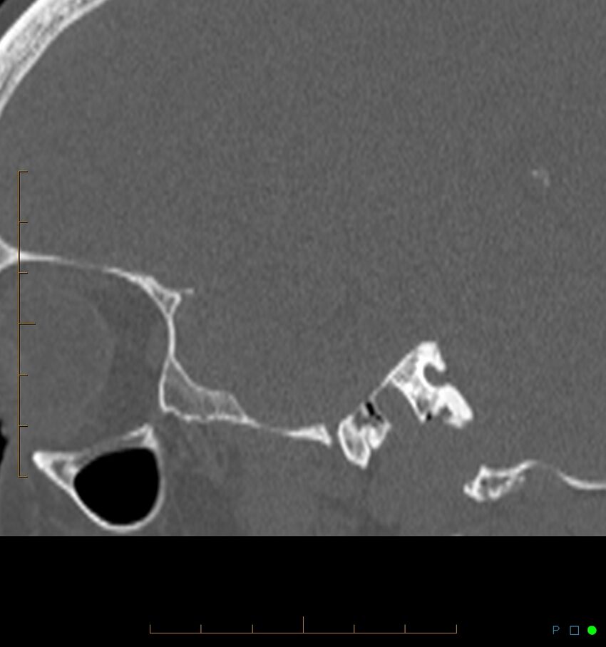 Benign notochordal cell tumor (probable) (Radiopaedia 65475-74546 Sagittal bone window 59).jpg