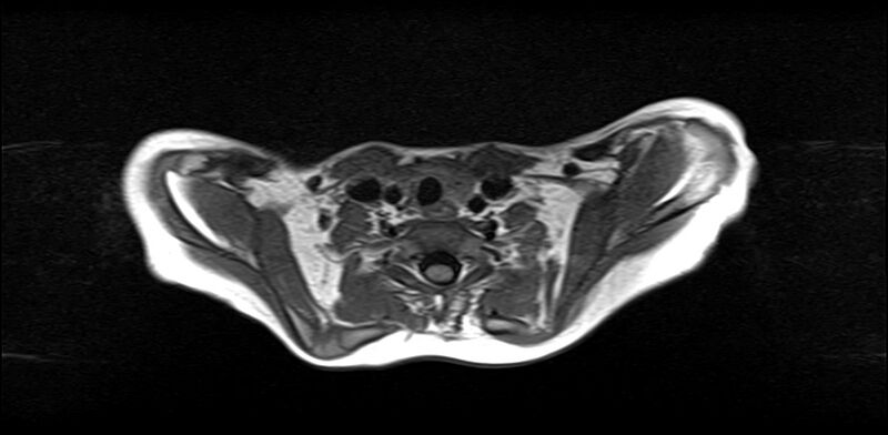 File:Bilateral Sprengel deformity with Klippel-Feil syndrome (Radiopaedia 66395-75650 Axial T1 18).jpg
