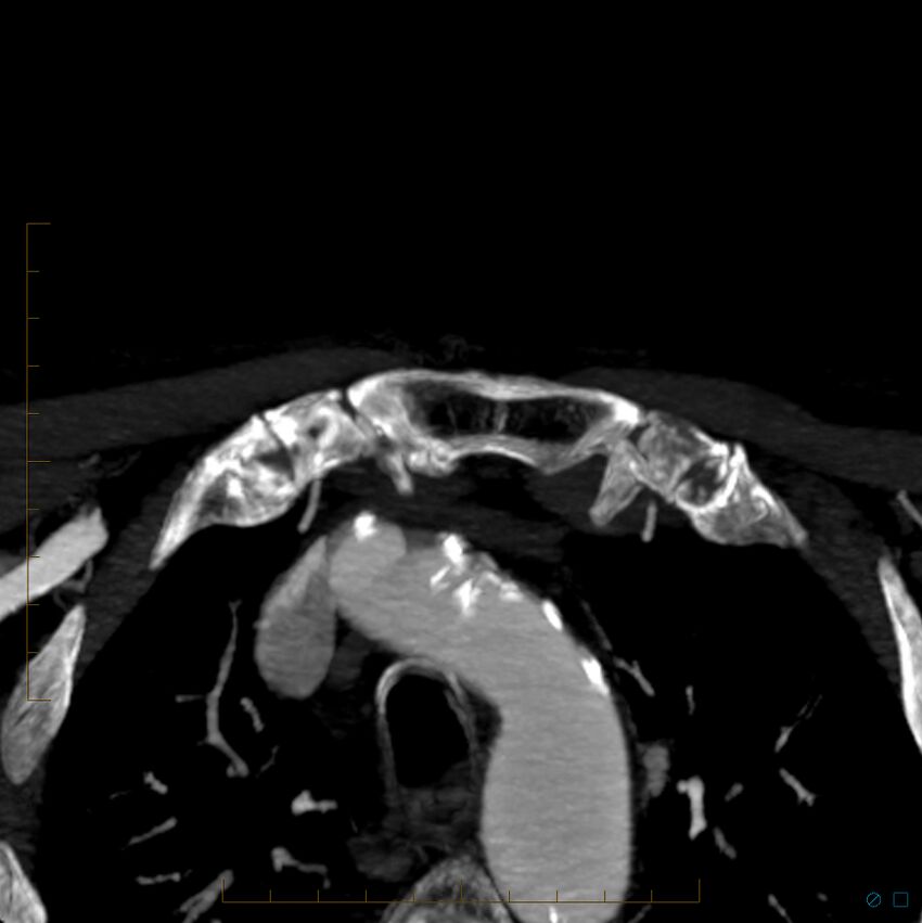 Bilateral chronic common carotid occlusion (Radiopaedia 50849-56362 D 59).jpg