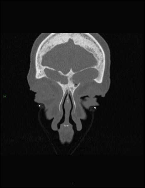 File:Bilateral frontal mucoceles (Radiopaedia 82352-96454 Coronal 63).jpg