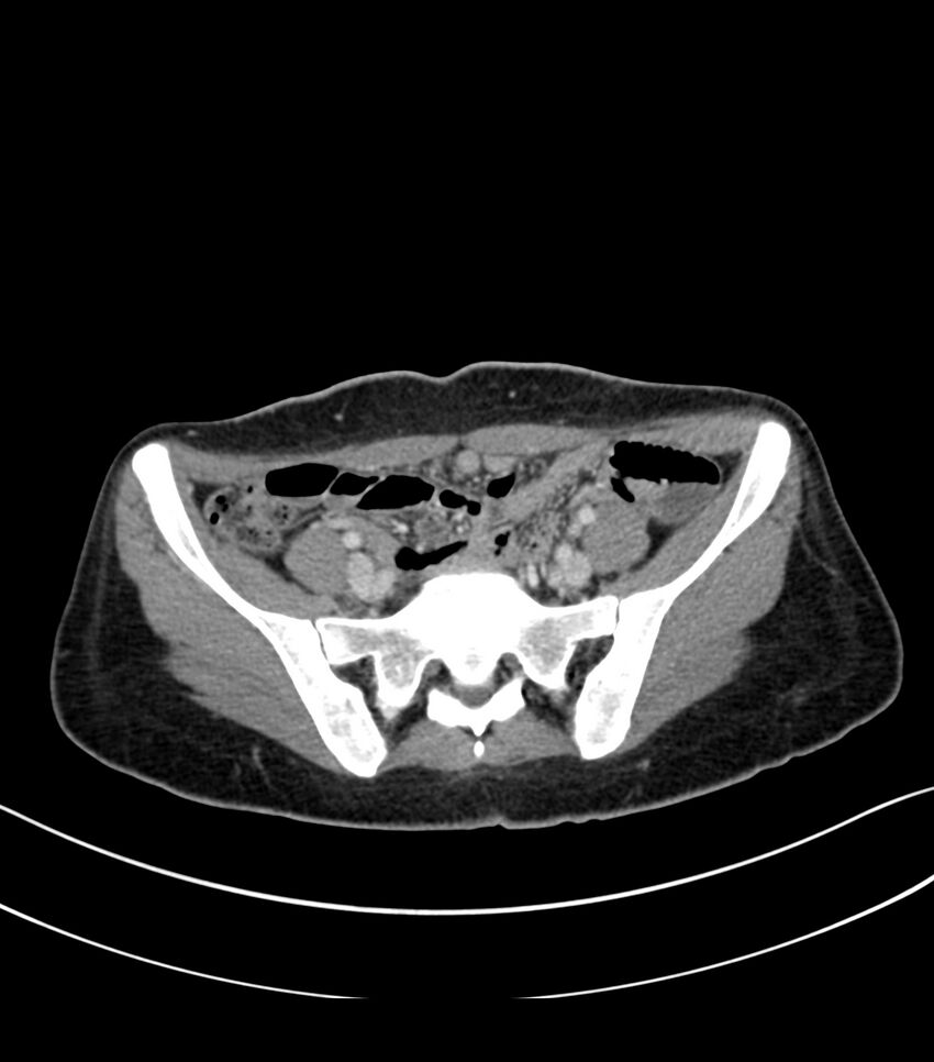Bilateral kidney malrotation (Radiopaedia 72227-82749 A 52).jpg