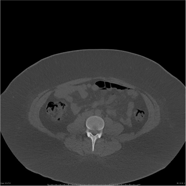 File:Bilateral lumbar ribs (Radiopaedia 25862-26010 bone window 29).jpg