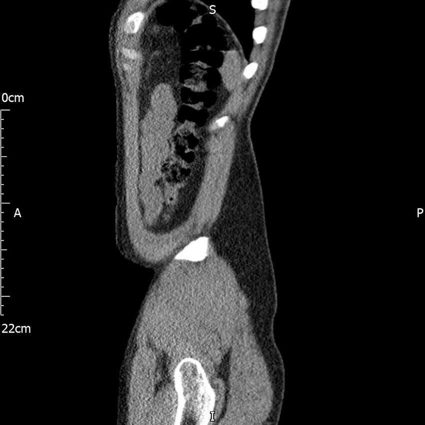 Bilateral medullary nephrocalcinosis with ureteric calculi (Radiopaedia 71269-81569 C 18).jpg