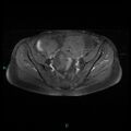 Bilateral ovarian fibroma (Radiopaedia 44568-48293 Axial T1 C+ fat sat 10).jpg