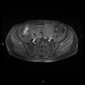 Bilateral ovarian fibroma (Radiopaedia 44568-48293 Axial T1 C+ fat sat 8).jpg