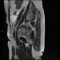 Bilateral ovarian fibroma (Radiopaedia 44568-48293 Sagittal T2 4).jpg