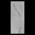 Bilateral popliteal artery entrapment (dynamic angiogram) (Radiopaedia 9420-10104 C 2).jpg