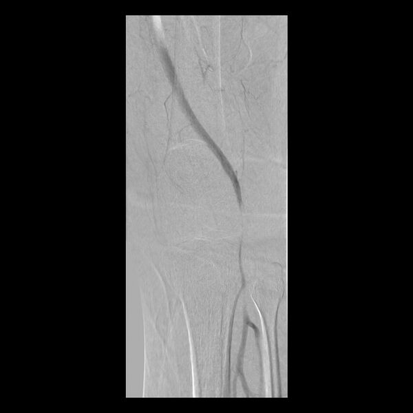 File:Bilateral popliteal artery entrapment (dynamic angiogram) (Radiopaedia 9420-10104 C 2).jpg