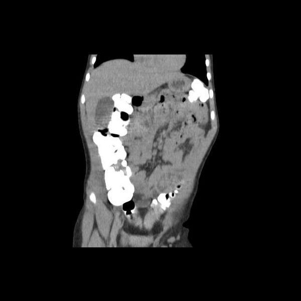 File:Bilateral renal malrotation (Radiopaedia 30901-31606 Coronal C+ delayed 8).jpg