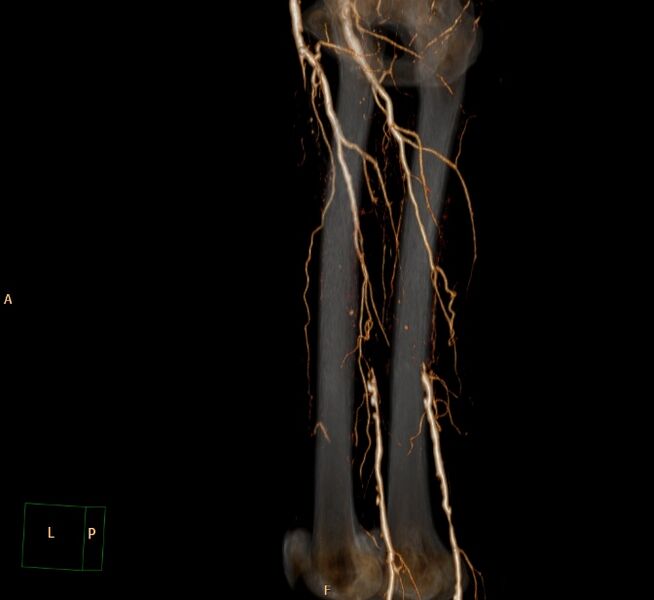 File:Bilateral superficial femoral arterial occlusion (Radiopaedia 25682-25857 3D VR 15).jpg
