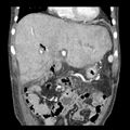 Biliary necrosis - liver transplant (Radiopaedia 21876-21846 C 13).jpg