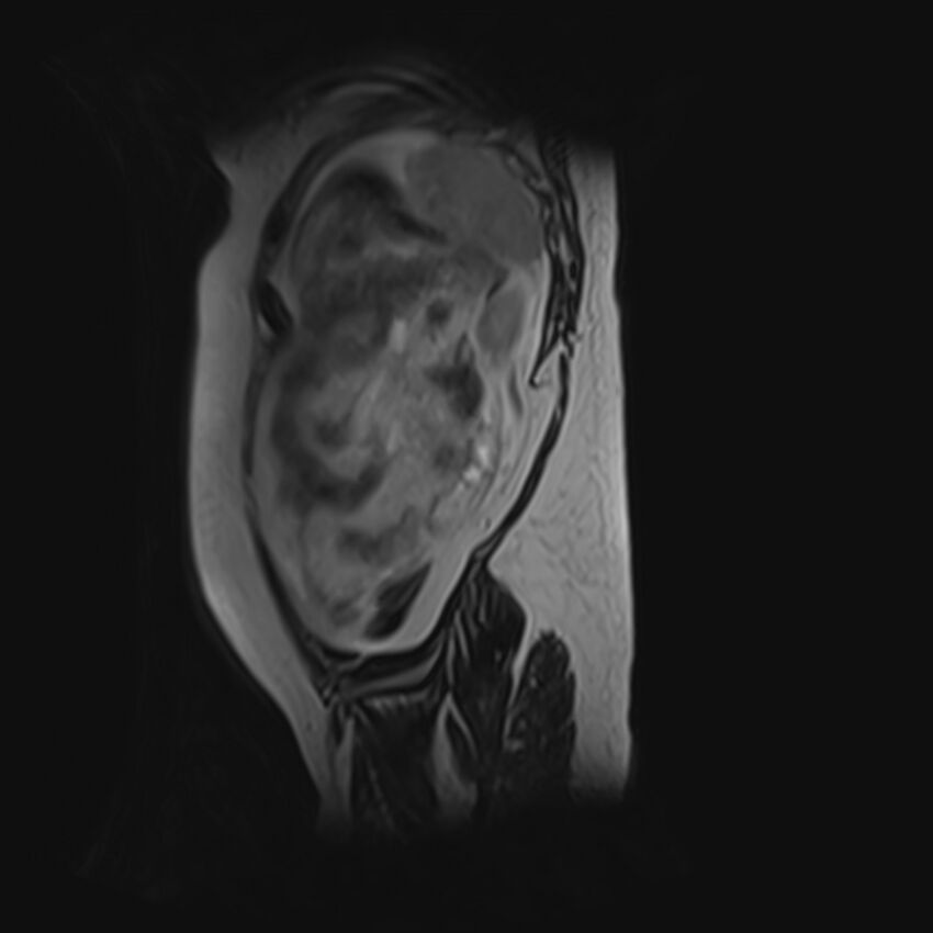 Bilobed placenta accreta (Radiopaedia 69648-79591 G 4).jpg