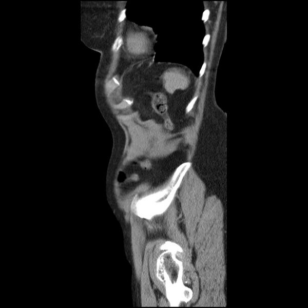 File:Bladder tumor detected on trauma CT (Radiopaedia 51809-57609 E 12).jpg