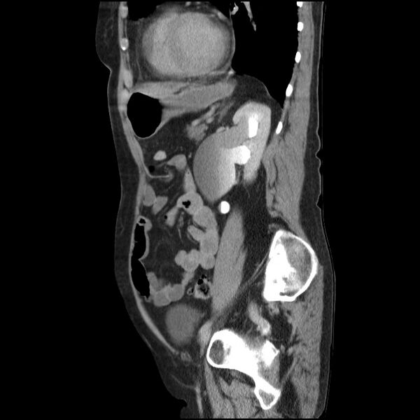 File:Bladder tumor detected on trauma CT (Radiopaedia 51809-57609 E 24).jpg