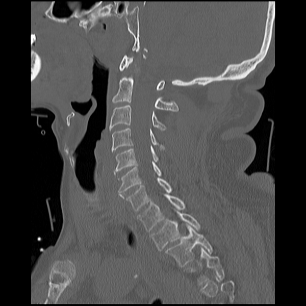 File:Blunt cerebrovascular injury (Radiopaedia 53682-59743 Sagittal bone window 10).png