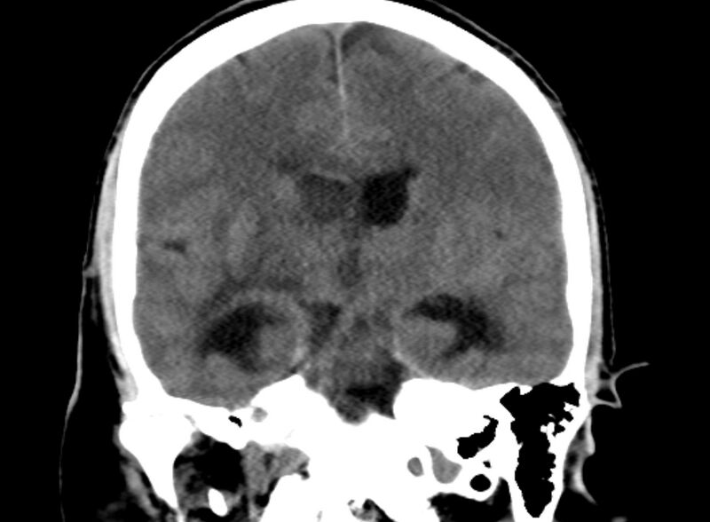 File:Brain abscess complicated by intraventricular rupture and ventriculitis (Radiopaedia 82434-96575 Coronal non-contrast 12).jpg