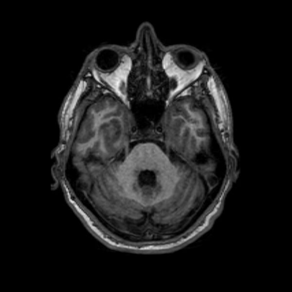 File:Brain abscess complicated by intraventricular rupture and ventriculitis (Radiopaedia 82434-96577 Axial T1 16).jpg