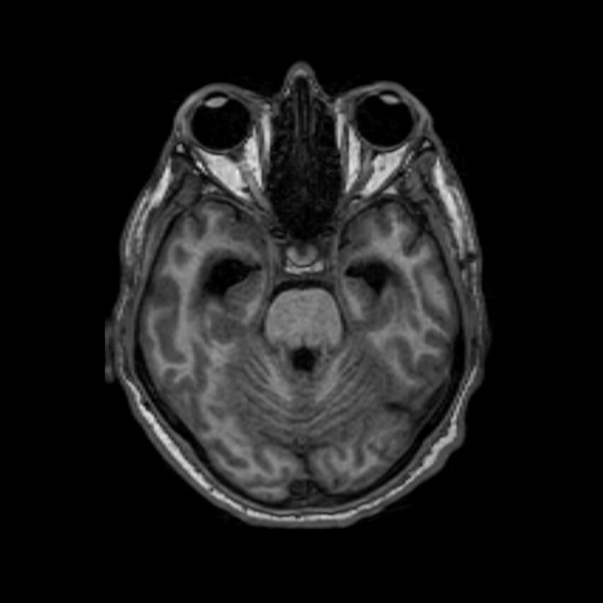 Brain abscess complicated by intraventricular rupture and ventriculitis (Radiopaedia 82434-96577 Axial T1 20).jpg