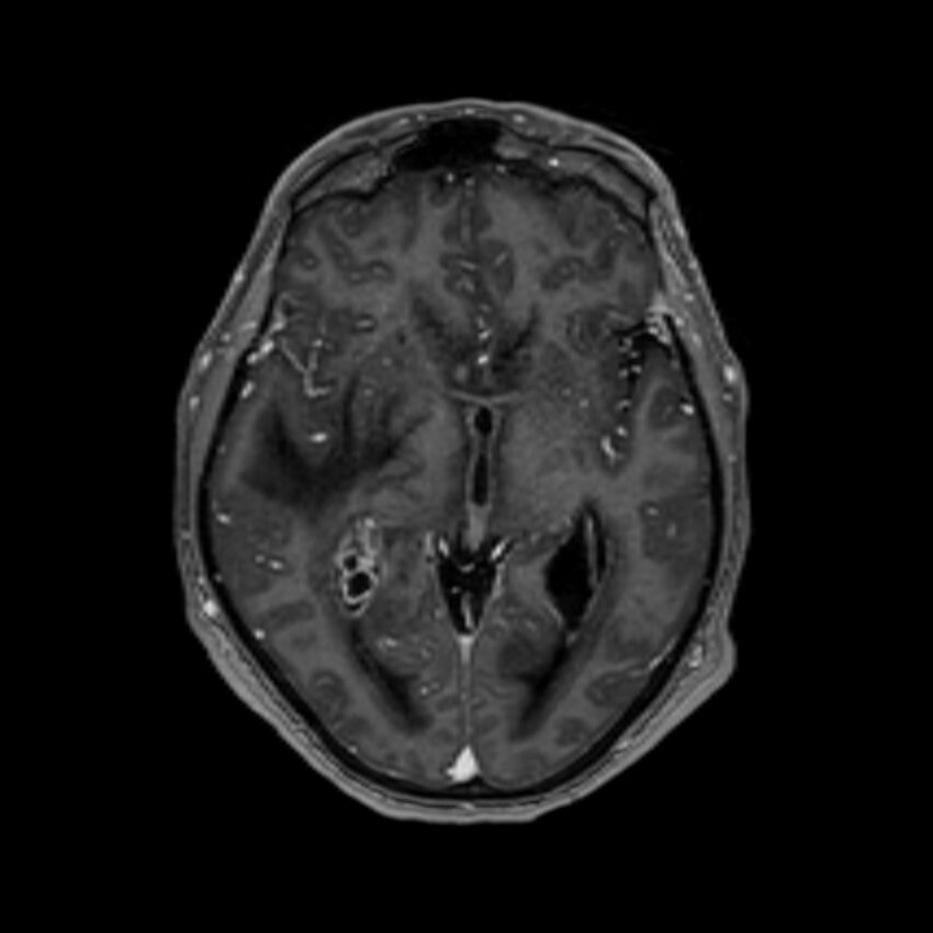 Brain abscess complicated by intraventricular rupture and ventriculitis (Radiopaedia 82434-96577 Axial T1 C+ 31).jpg