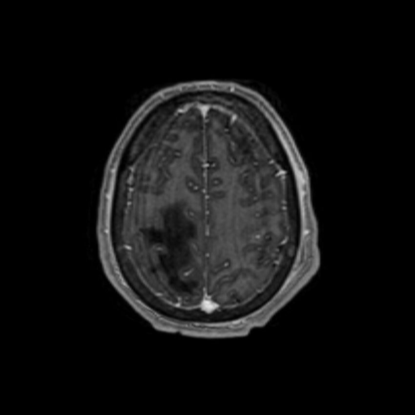 Brain abscess complicated by intraventricular rupture and ventriculitis (Radiopaedia 82434-96577 Axial T1 C+ 58).jpg