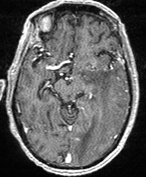File:Brain abscess with dual rim sign (Radiopaedia 87566-103938 Axial T1 C+ 73).jpg