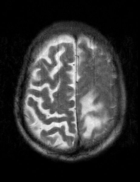 File:Brain abscess with dual rim sign (Radiopaedia 87566-103938 Axial T2 20).jpg
