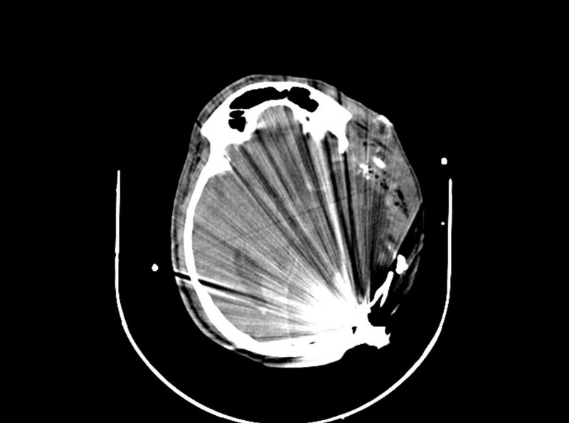File:Brain injury by firearm projectile (Radiopaedia 82068-96087 B 99).jpg