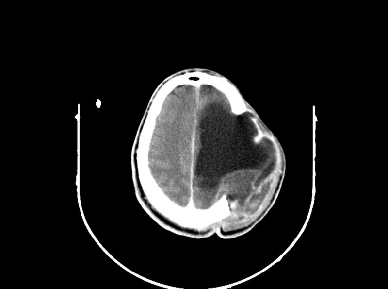 File:Brain injury by firearm projectile (Radiopaedia 82068-96088 B 172).jpg
