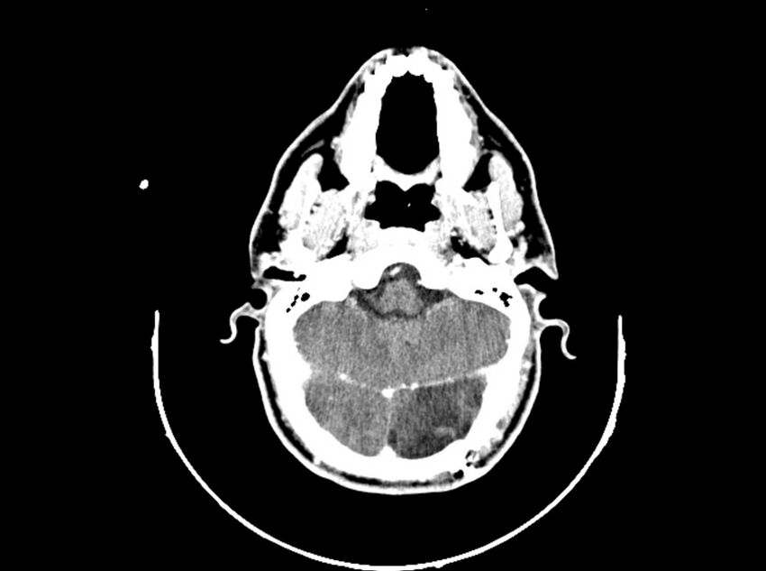 Brain injury by firearm projectile (Radiopaedia 82068-96088 B 80).jpg