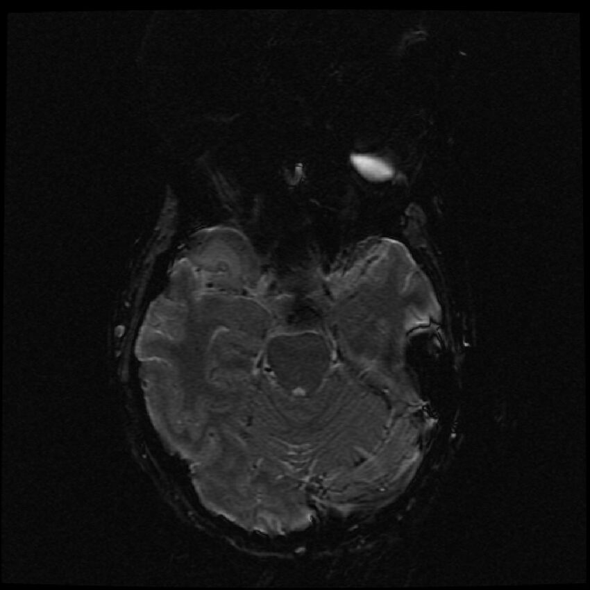 Brain metastases (renal cell carcinoma) (Radiopaedia 42571-45704 Axial SWI 42).jpg