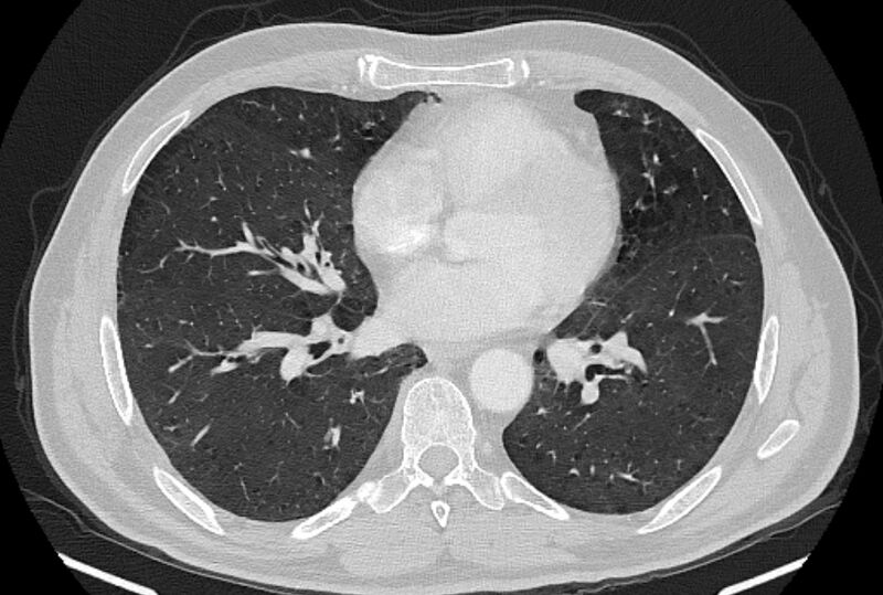 File:Brain metastases - lung cancer primary (Radiopaedia 75060-86116 Axial lung window 35).jpg