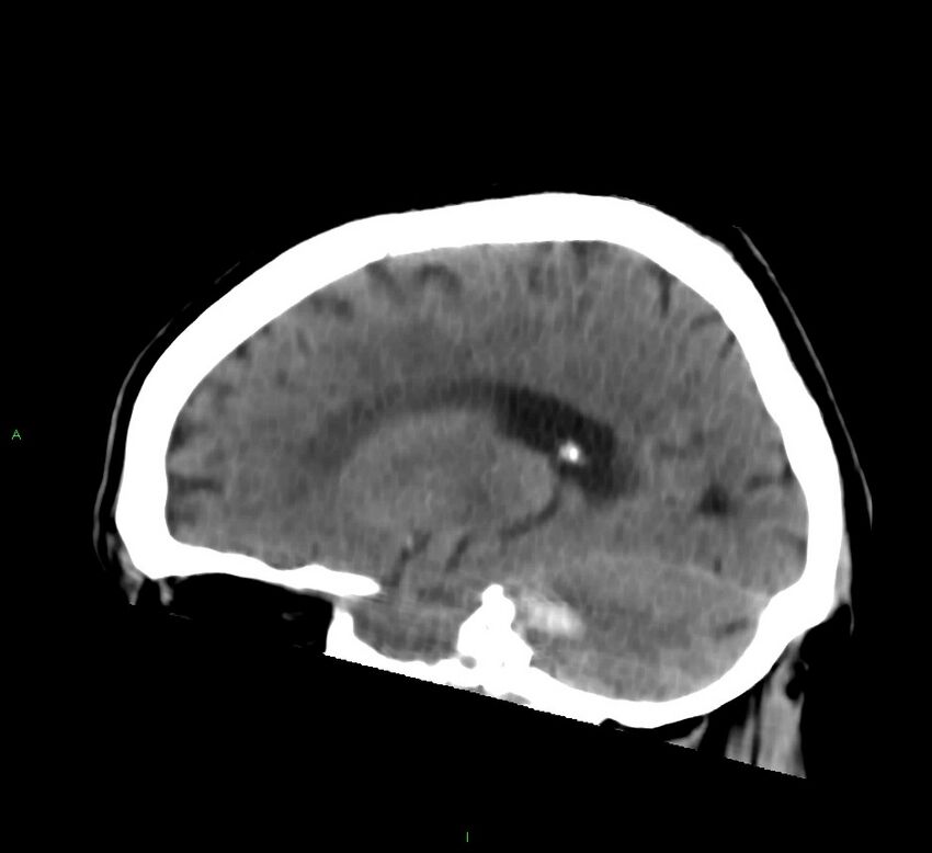 Brainstem hemorrhage (Radiopaedia 58794-66028 C 33).jpg