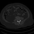 Breast carcinoma with pathological hip fracture (Radiopaedia 60314-67993 Axial bone window 2).jpg