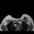 Breast implants - MRI (Radiopaedia 26864-27035 Axial T1 43).jpg