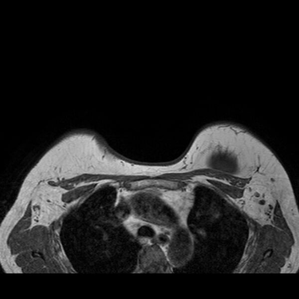 File:Breast implants - MRI (Radiopaedia 26864-27035 Axial T1 43).jpg